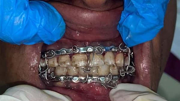 إجراء عملية جراحية