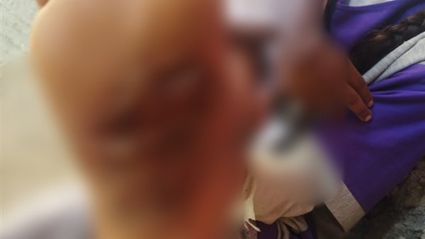 آثار التعذيب