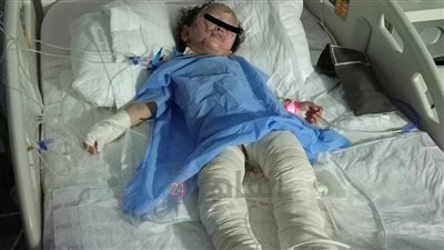 حروق بكامل الجسد.. أب يحذر من شركة وايت بوينت بعد انفجار بوتجاز في ابنته: أجرت 5 عمليات وكلمتهم عملولي بلوك