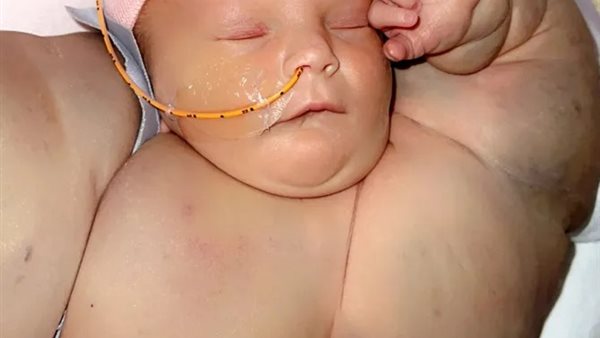 ولادة نادرة 