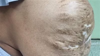 فريق طبي بمستشفى التأمين الصحي ببنها ينقذ حياة مسن بإجراء عملية فتك جراحى كبير 