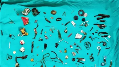 منها سماعات أذن.. أطباء يعثرون على 150 أداة في معدة مريض بعد معاناته لمدة عامين بالهند