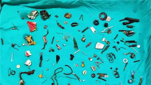 أطباء يعثرون على