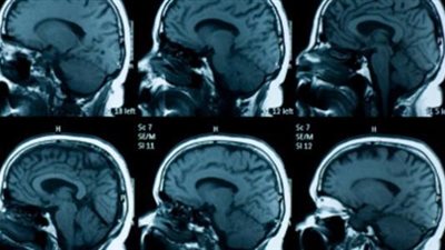 بيتولدوا طبيعيين..أب يستغيث لعلاج أولاده: بيوصلوا لسن معين وتظهر عليهم أعراض ضمور المخ