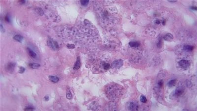 الصحة البريطانية تحذر من ارتفاع حالات الإصابة بالديدان الطفيلية