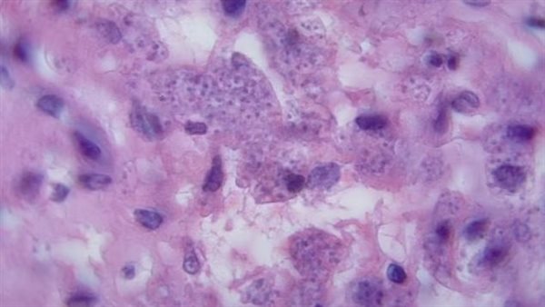 الديدان الطفيلية