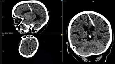 أدخلها والداها لقتلها..عجوز تكتشف إبرة 3 سم في دماغها بروسيا 