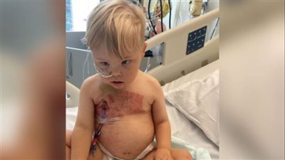 يعاني من طفح جلدي.. إصابة طفل بريطاني بورم سرطاني نادر