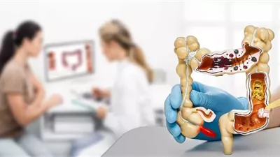 دراسة: دواء الاكتئاب والصداع النصفي يساهم في علاج مرض القولون العصبي