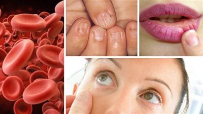 بعد تحذيرات منه.. ما هو فقر الدم المنجلي؟