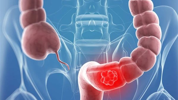 علاج القولون العصبى