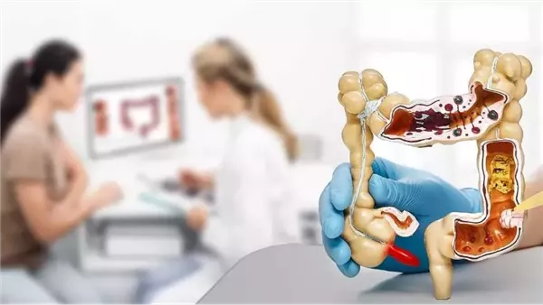 علاج القولون العصبي