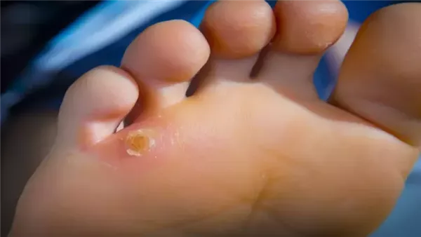 علاج مسمار القدم