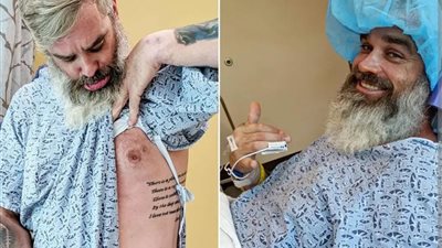 يمثل 1% من الحالات في الولايات المتحدة.. أمريكي مصاب بسرطان الثدي للرجال النادر