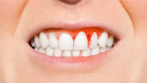 التهاب اللثة 