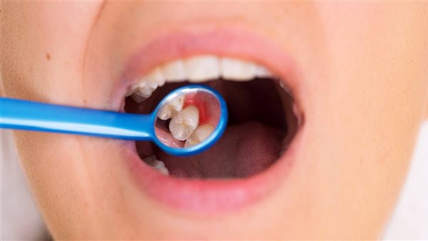 علاج التهاب اللثة