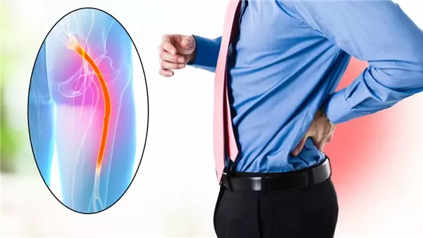 علاج عرق النسا