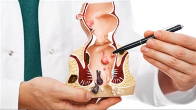 منها أكياس الشاي والثوم.. علاج البواسير الخارجية للرجال والنساء 