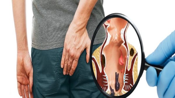 علاج البواسير 