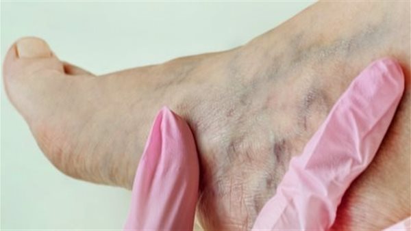 تجلط الأوردة العميقة