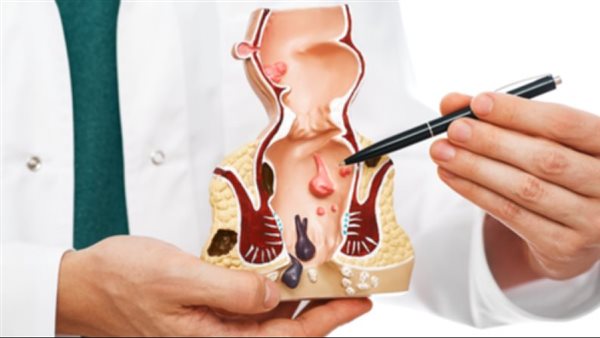 علاج البواسير الخارجية