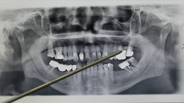 أشعة الأسنان 