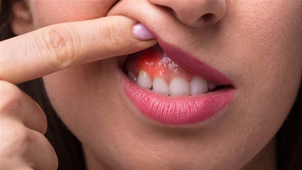 خراج الأسنان