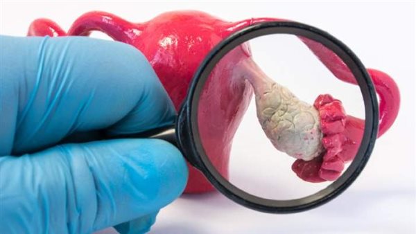 متلازمة تكيس المبايض