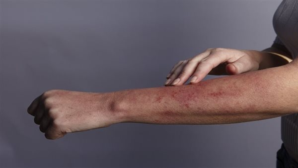  علاج الآفات الجلدية