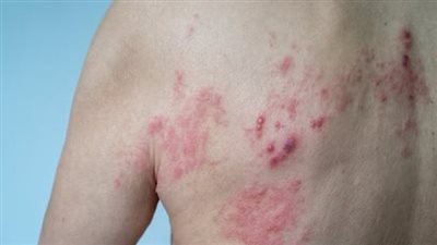 ما هي أعراض القوباء المنطقية.. وأسبابها وكيفية علاج الفيروس