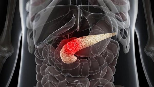  سرطان البنكرياس