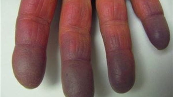 متلازمة رينود