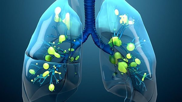 التليف الكيسي