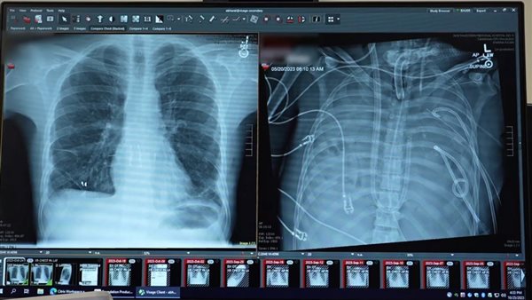 عملية زراعة ثديين