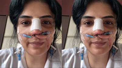 من 3 سنين بتكلفة 12 مليون جنيه.. القصة الكاملة لعمليات حورية فرغلي في الأنف