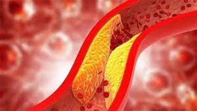 5 إجراءات احرص عليها قبل فحص الكوليسترول