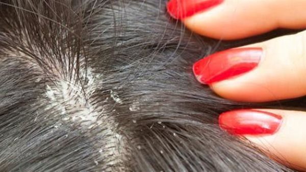 تفسير حلم القمل 