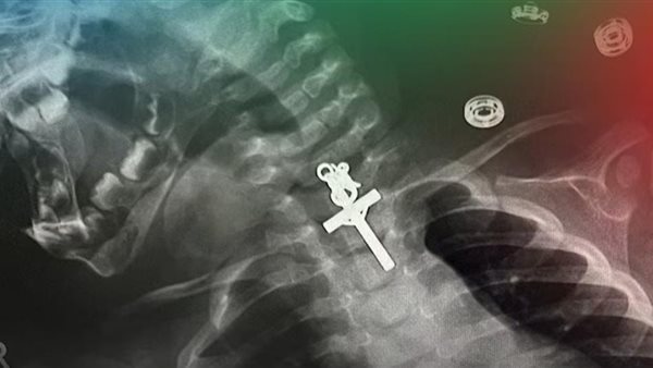 إزالة صليب من حلق