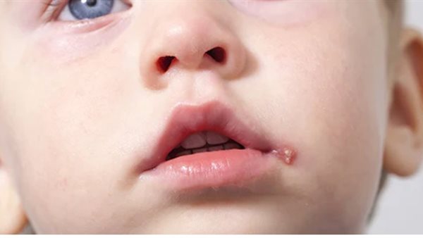 الهربس لدى الأطفال