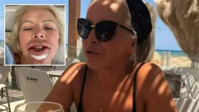 إصابة سيدة أمريكية بسرطان الخلايا الحرشفية بسبب الفيلر