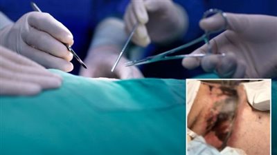 تعفن الجلد.. إصابة سيدة بمضاعفات خطيرة بعد جراحة شفط الدهون وشد البطن