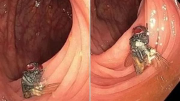 أشعة المنظار 