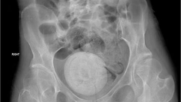 حصوة بحجم برتقالة