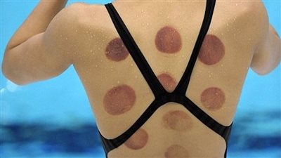  الحجامة وفوائدها.. شروطها وأيامها ورأي الإسلام فيها