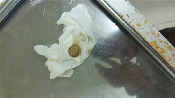 انقاذ حياة طفل بلع