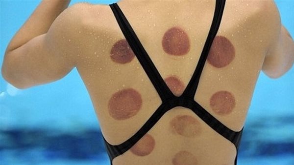 الحجامة وفوائدها