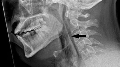 كان هيموت.. تسجيل أول حالة تمزق في القصبة الهوائية لشخص بسبب كتم العطس