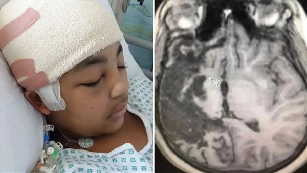 التهاب الدماغ