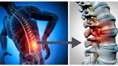 تعرف على أسباب وطرق الوقاية من الانزلاق الغضروفي 