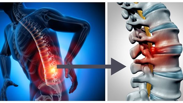 الانزلاق الغضروفي